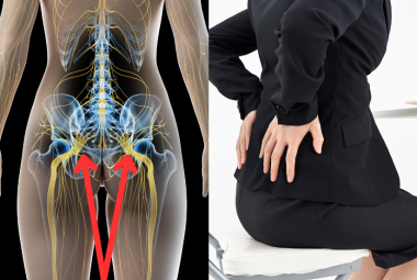 bilateral sciatica