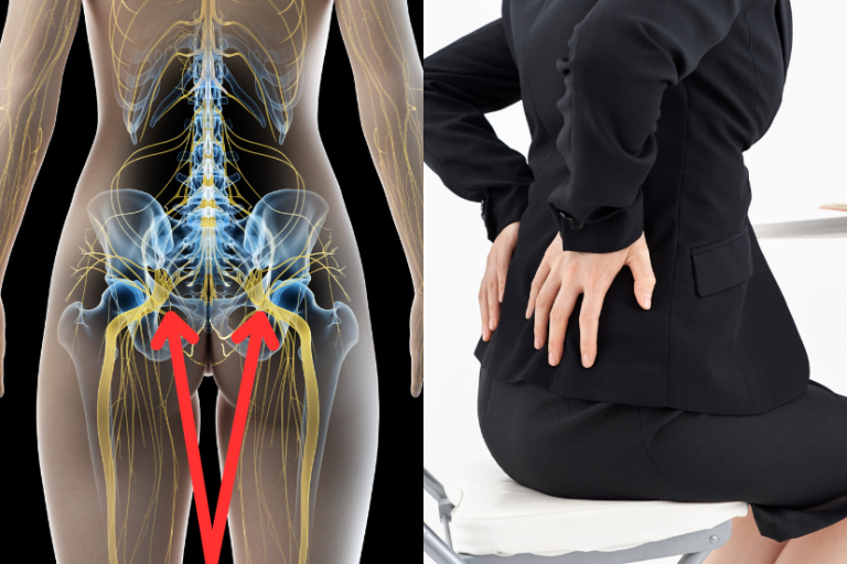 Low Back Pain Due To Bilateral Sciatica Icd 10