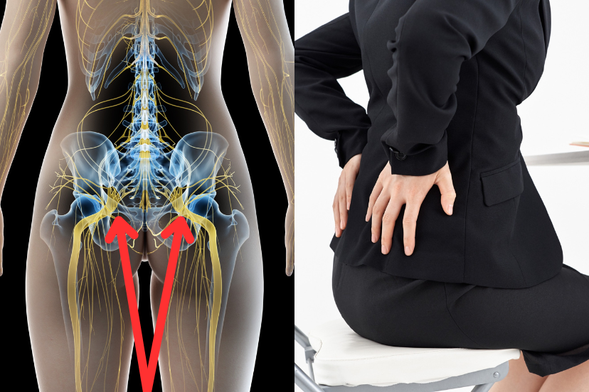 back pain with bilateral sciatica icd 10