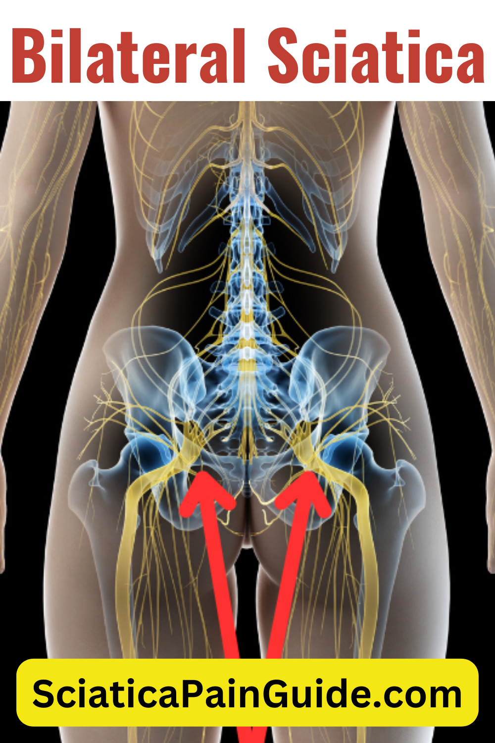 lbp with bilateral sciatica icd 10