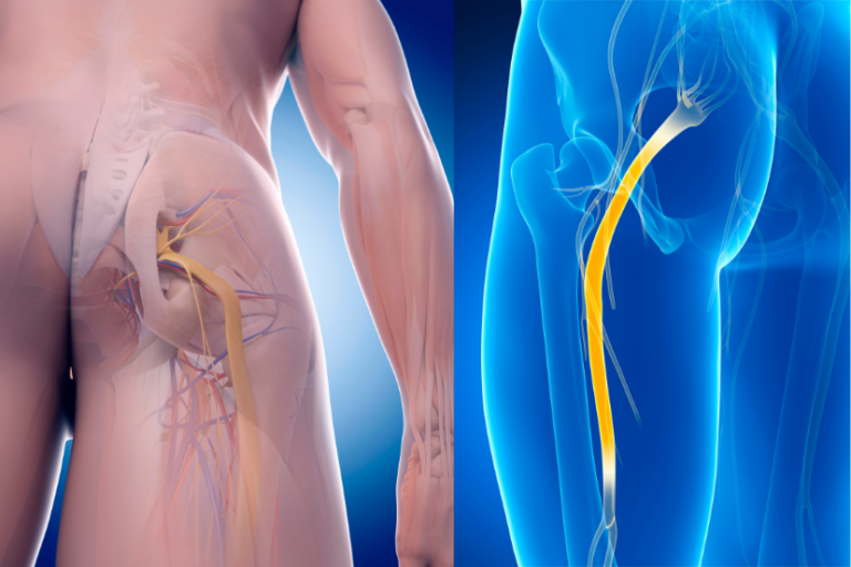 Sciatica Relapse Sciatic Nerve Decompression - Sciatica Pain Guide