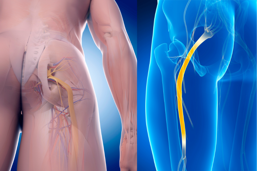 Sciatic Nerve Decompression