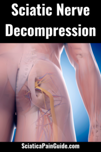 Sciatic Nerve Decompression pin