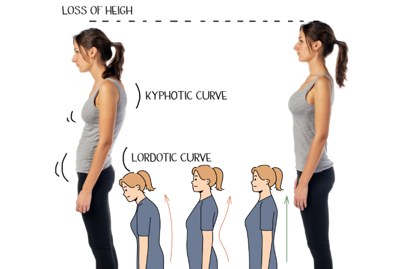 Good Posture and Sciatica