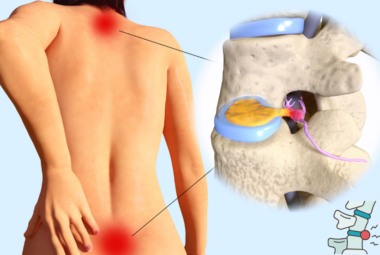 Sciatica-and-Herniated-Discs
