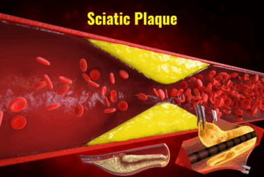 Sciatic Plaque