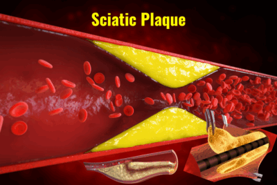 Sciatic Plaque 97% of Sciatica Sufferers Miss this Simple Pain Trigger